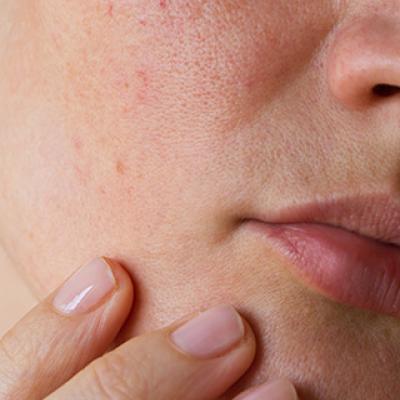 Dry face remedies discount